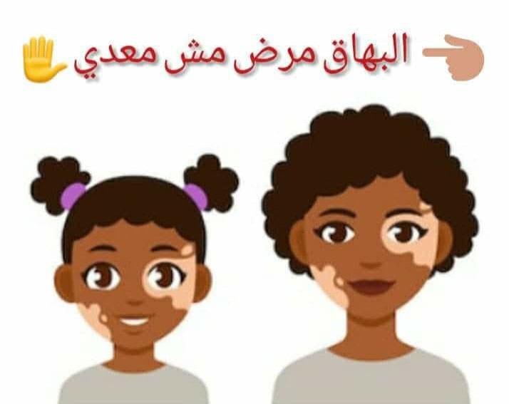 البهاق مرض من أمراض المناعة الذاتية وهو غير معدي