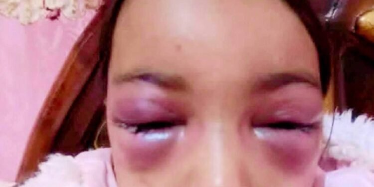 مرآة اب مجردة من الرحمة تتعدى على طفلين بالضرب المبربالشرقية