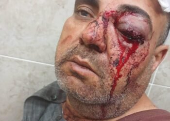 حاول التدخل لفض مشاجرة طلابية ففقد عينيه