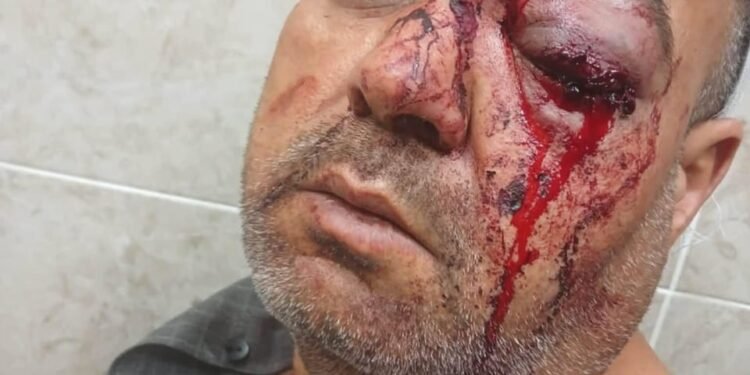 حاول التدخل لفض مشاجرة طلابية ففقد عينيه