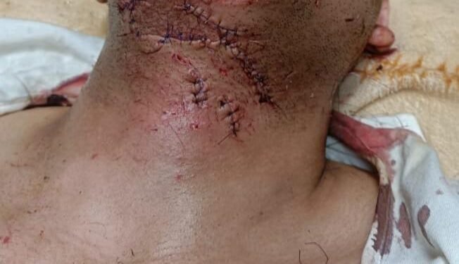 تدخل فوري من أطباء مستشفي الطوارئ بجامعة سوهاج ينقذ حياة شاب تعرض لاصابات بالغه وجروح متهتكة ونزيف حاد